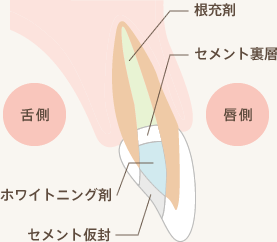 ウォーキングブリーチの仕組み