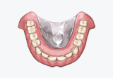 金属床義歯（チタン）
