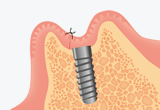 インプラント埋入