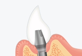 インプラント上部構造