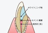 ウォーキングブリーチ