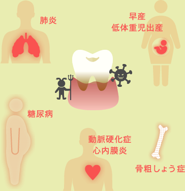 「肺炎」「早産低体重児出産」「糖尿病」「動脈硬化症心内膜炎」「骨粗しょう症」などに繋がります。